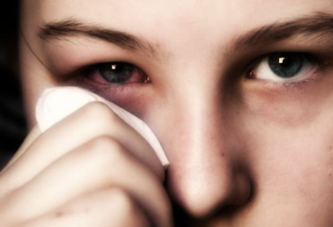 Conjuntivite primaveril não é contagiosa, mas é preciso estar alerta